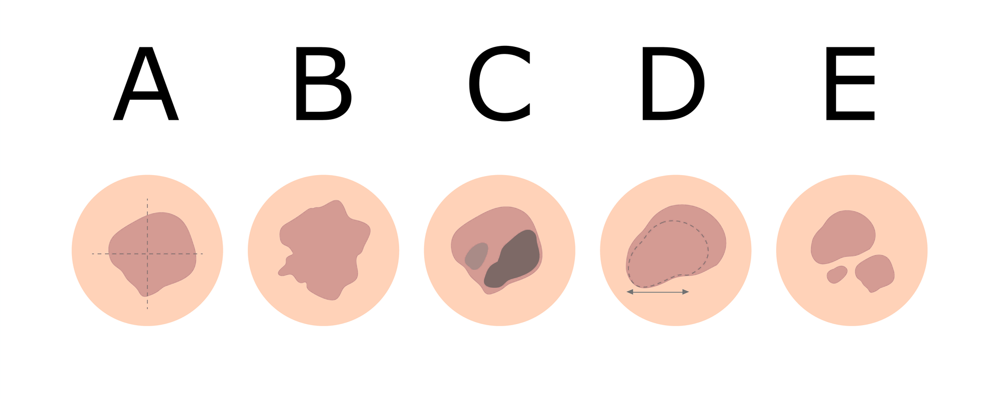ABCDE-Regel zur Beurteilung von Muttermalen